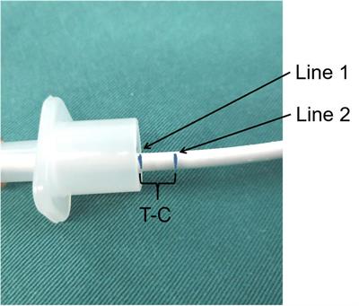 Effect of head position changes on the depth of tracheal intubation in pediatric patients: A prospective, observational study